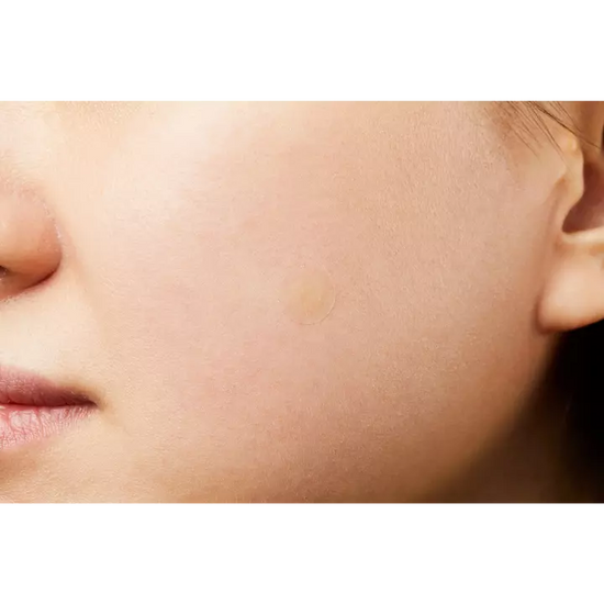 Acne Pimple Master Patch Set (90 patches)