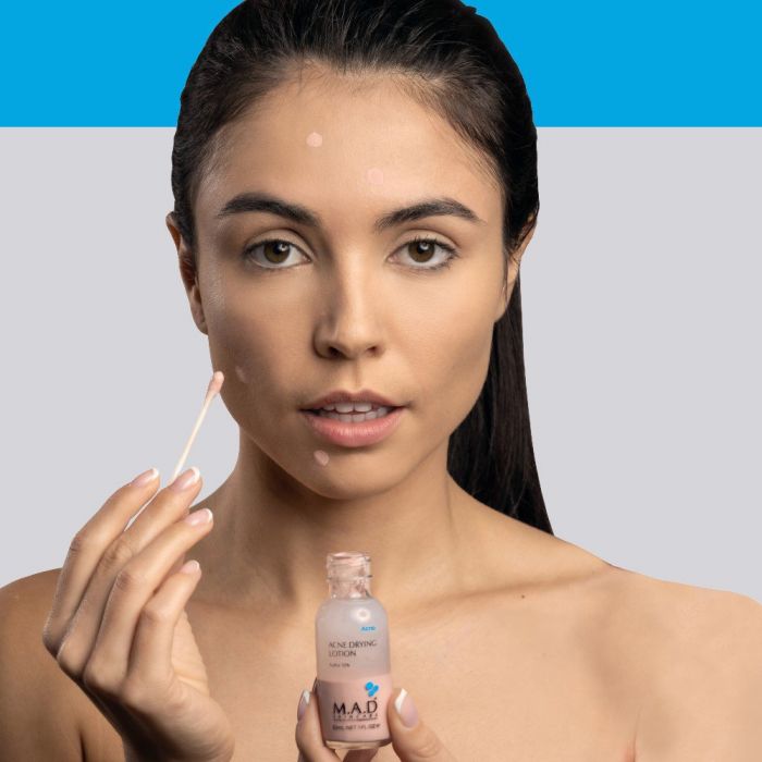 Acne Drying Lotion Sulfur 10%